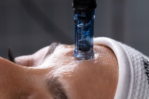 5SR_0229-Edit.jpg Microneedling 1